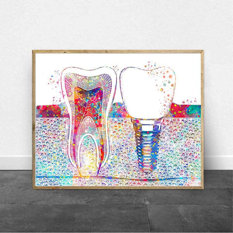 Implantology Premium Canvas - Dental Wall Art - TOOTHLET