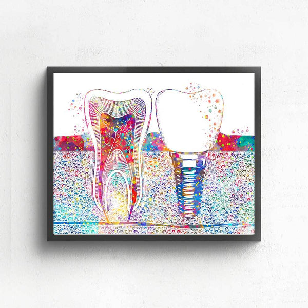 Implantology Premium Canvas - Dental Wall Art - TOOTHLET